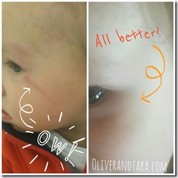 Ouch! How we treated our first black eye | found at http://www.oliverandtara.com